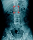 x-ray fixation lumbar