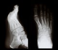 X-ray of a foot