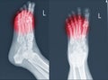 X-ray foot and ankle showing Metatarsal fractures