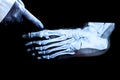 X-ray of the foot with growths on the bone Royalty Free Stock Photo