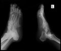 X-ray of the foot. Exostosis of the 5th metatarsal bone. Marker.