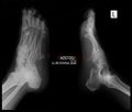 X-ray of the foot. Exostosis of the 5th metatarsal bone. Marker. Royalty Free Stock Photo