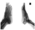 X-ray of the foot. Exostosis of the 5th metatarsal bone. Negative. Royalty Free Stock Photo