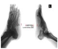 X-ray of the foot. Exostosis of the 5th metatarsal bone. Negative. Marker. Royalty Free Stock Photo