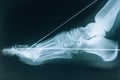 X-ray of the foot. Fracture of the bones of the foot. Bone fixation pins