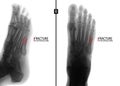 X-ray of the foot. Fracture of the 5th metatarsal bone. Marker. Negative.