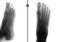 X-ray of the foot. Fracture of the 5th metatarsal bone. Negative.