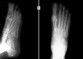 X-ray of the foot. Fracture of the 5th metatarsal bone.