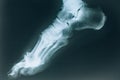 X-ray of the foot. Injury to the bones of the foot. Sports injury Royalty Free Stock Photo