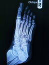 x-ray foot Oblique view showing fracture neck of metatarsal bone .