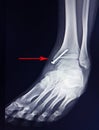 X-ray foot after operation fix screws in medial malleolus tibia.