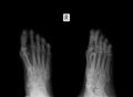 X-ray of the foot. Osteochondropathy of the 3th metatarsal bone.