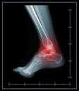 X-ray foot painful ankle area. Royalty Free Stock Photo