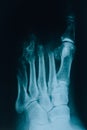 X-ray of the foot. A real x-ray picture of a sore foot. At the doctorÃ¢â¬â¢s appointment, hospital. Royalty Free Stock Photo