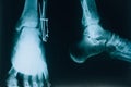 X-ray of the foot. A real x-ray picture of a sore foot. At the doctorÃ¢â¬â¢s appointment, hospital. Royalty Free Stock Photo