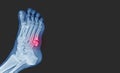 X-ray foot showing toe 5th bone fracture base of metatarsal fracture from against the wall. Highlight on fracture site and