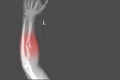 X-ray forearm AP views showing Fracture proximal Left radius and soft tissue swelling on red point ,medical image concept