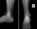 X-ray Fracture of medial ankle of right shin with metal structure