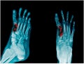 Fracture metatasal bone of right foot