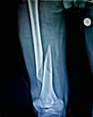 X-Ray of fracture right thigh in 50 year old man