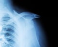 X-ray of a fractured humeral head and shoulder dislocation. Clavicle fracture. Traumatology and orthopedics., close-up Royalty Free Stock Photo