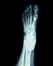 X-ray of the front foot Hallux Valgus surgery