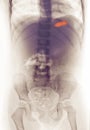 X-ray of a girl who swallowed a toy