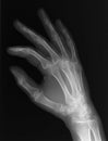 X-ray of hand