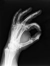 X-ray hand