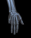 X ray of hand with amputated little finger Royalty Free Stock Photo