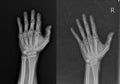 X-ray Hand AP,OBLIQUE:fracture mid shaft Rt.2nd. metacapal bone soft tissue swelling.