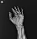 X-ray Hand AP,OBLIQUE:fracture mid shaft Rt.2nd. metacapal bone.