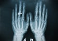 X-ray hand (finger) Royalty Free Stock Photo