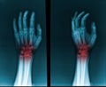 X-ray hand and finger, highlighted in red