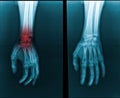 X-ray hand and finger, highlighted in red