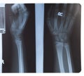 X-ray of hand and forearm