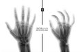 X-ray of the hand. Fracture of the 3rd metacarpal bone the child. Marker. Negative. Royalty Free Stock Photo