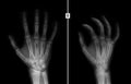 X-ray of the hand. Fracture of the 3rd metacarpal bone the child.