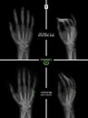 X-ray of the hand. Fracture of the 5rd metacarpal bone. Reposition. Osteosynthesis. Marker. Royalty Free Stock Photo