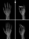 X-ray of the hand. Fracture of the 5rd metacarpal bone. Reposition. Osteosynthesis. Royalty Free Stock Photo