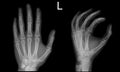 X-ray hand Frontal Oblique view normal