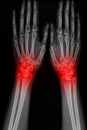 X-ray hand of man with arthritis