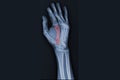 X-ray hand showing 2th Metacarpal fracture.Medical image concept