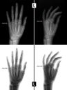 X-ray of the hand. Shows the Fracture of the base of the proximal phalanx of the fifth finger of the left hand. Marker. Positive. Royalty Free Stock Photo