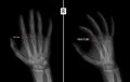 X-ray of the hand. Shows the Fracture of the base of the proximal phalanx of the second finger of the right hand. Marker. Negative Royalty Free Stock Photo