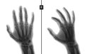 X-ray of the hand. Shows the Fracture of the base of the proximal phalanx of the second finger of the right hand. Marker. Negative Royalty Free Stock Photo