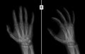 X-ray of the hand. Shows the Fracture of the base of the proximal phalanx of the second finger of the right hand. Royalty Free Stock Photo