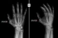 X-ray of the hand. Shows the subluxation of the proximal phalanx of the first finger of the right hand. Marker. Royalty Free Stock Photo