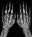 X-ray of hands