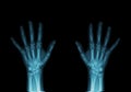 X-Ray of hands Royalty Free Stock Photo